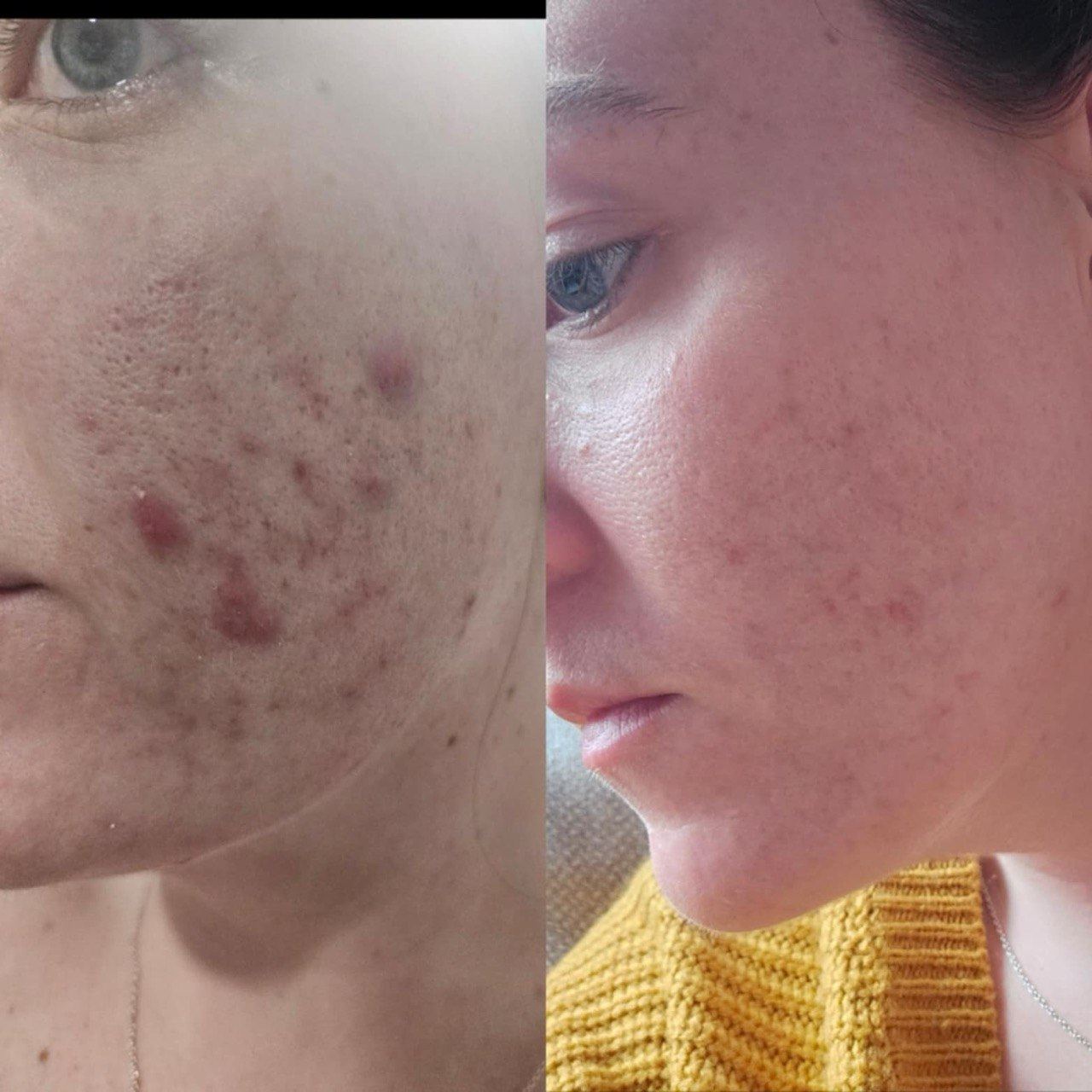 Before and after face peel treatment