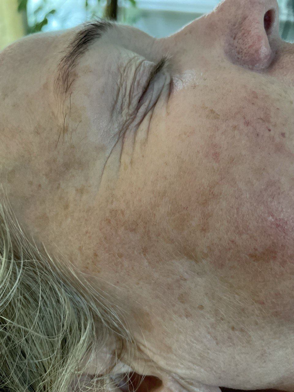 Before Winback facial treatment